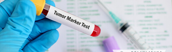 Tumorski marker za žene ili muškarce - otkrijte tumor na vrijeme u Poliklinici Analiza Lab, bez najave i uz nalaze gotove isti dan