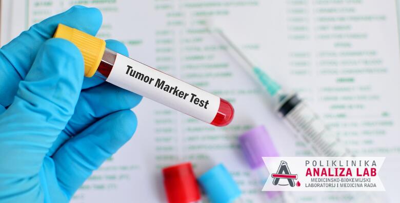 Ponuda dana: Tumorski marker za žene ili muškarce - otkrijte tumor na vrijeme u Poliklinici Analiza Lab, bez najave i uz nalaze gotove isti dan (Poliklinika Analiza Lab)