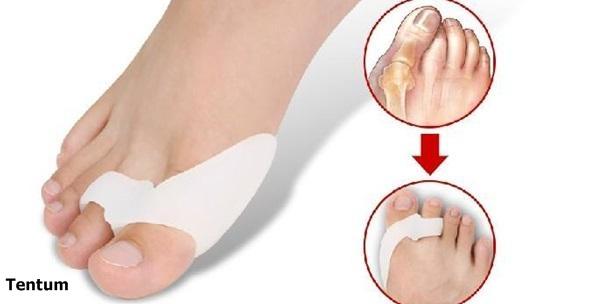 2 anatomska silikonska štitnika za deformirane i zakrivljene nožne palčeve Hallux Valgus za 59kn!