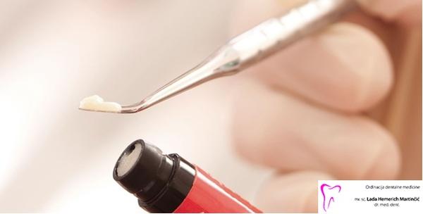 2 plombe uz pregled u Ordinaciji dentalne medicine mr.sc. Lada Hemerich Martinčić, dr.med.dent