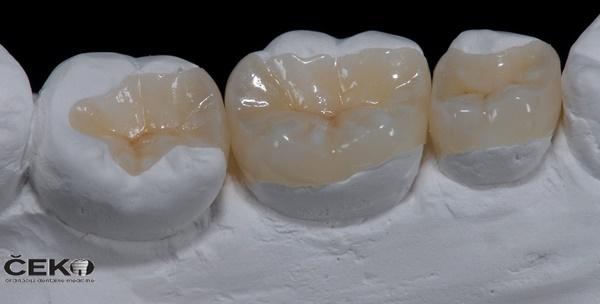 Zubni implantat -53% Rudeš