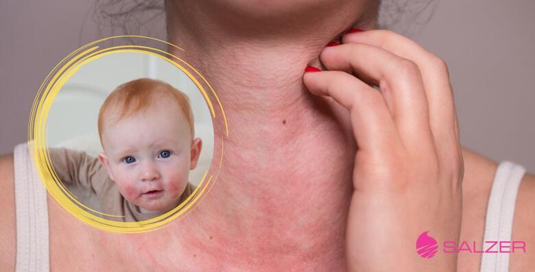 TESTIRANJE ALERGIJA – provjerite 8 najčešćih alergena putem krvi i saznajte smetaju li vam jaja, mlijeko, pšenica, kikiriki, soja, lješnjak, grinje ili kućna prašina