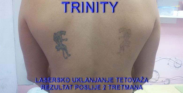 Lasersko uklanjanje tetovaže veličine do 10×10 cm u Laser centru Trinity za 279kn!