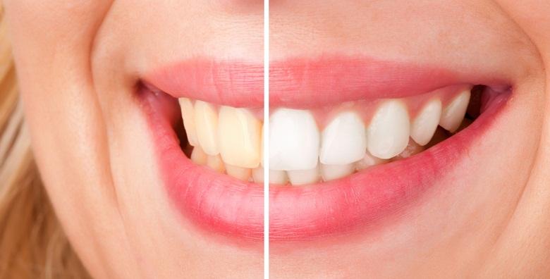 Izbjeljivanje zubi -78% Kvatrić