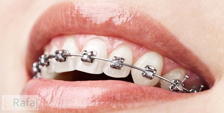 Aparatić za zube -39% Kvatrić