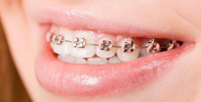 Aparatić za zube -43% Kvatrić