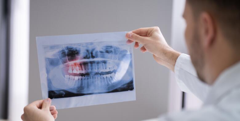POPUST: 56% - CT gornje i donje čeljusti sa sinusima CBCT uređajem za najsuvremenije snimke koštane anatomije i BESPLATAN PREGLED u Poliklinici Premium Dent (Poliklinika Premium dent)