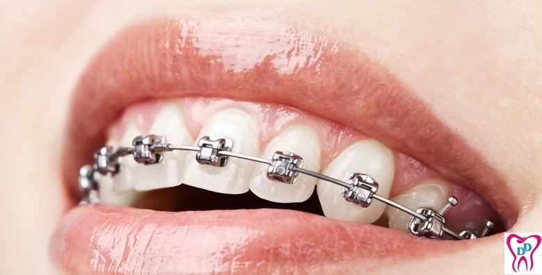 [APARATIĆ ZA ZUBE] Estetski keramički ili konvencionalni metalni uz uključene sve preglede u Ordinaciji Dami Dent od 4.250 kn!