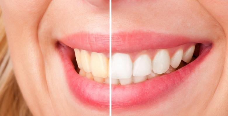 Izbjeljivanje zubi Opalescence Boost gelom i Smilite lampom
