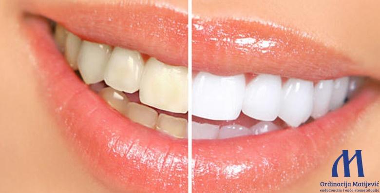 MEGA POPUST: 71% - Izbjeljivanje zubi Opalesscence Boost tehnologijom u ordinaciji ili pomoću udlaga - najučinkovitiji, najbrži i najsigurniji tretman za blistav osmjeh od 699 kn! (Ordinacija dentalne medicine Matijević)