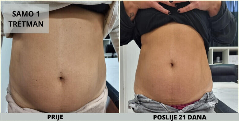 CryocoolSculpting 360 ili 4D -82%