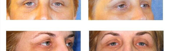 Blefaroplastika - pomladite se uz zahvat na oba oka i uključenu anesteziju i kontrolu nakon zahvata uz NAJdoktora Bojana Ignatovskog u Poliklinici Arcadia