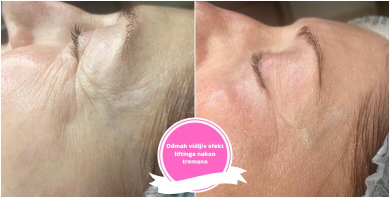KOLAGEN NITI – potpuno prirodna i neinvazivna metoda smanjivanja bora te liftinga lica s odmah vidljivim rezultatima u Studiju ljepote Manuela