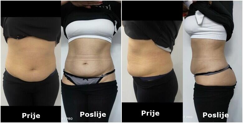 CRYOCOOLSCULPTING – vrhunski tretman za mršavljenje zamrzavanjem masnih stanica – efekt 3 tretmana u 1 uz gratis limfnu drenažu