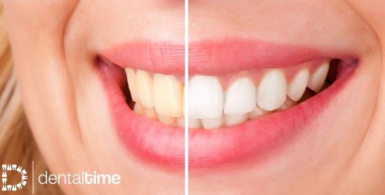 POPUST: 35% - Izbjeljivanje zubi ili ugradnja kompozitne ljuskice - brzo i bezbolno osigurajte savršenu bjelinu zubi i pokažite svima blistav osmijeh od 390 kn! (Stomatološka ordinacija Dental Time)