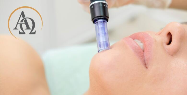 POPUST: 59% - Prirodnim putem potaknite obnovu kože te uklonite bore i ožiljke uz tretmane microneedlinga i dijamantne mikrodermoabrazije (Alpha et Omega - Beauty & fit centar)