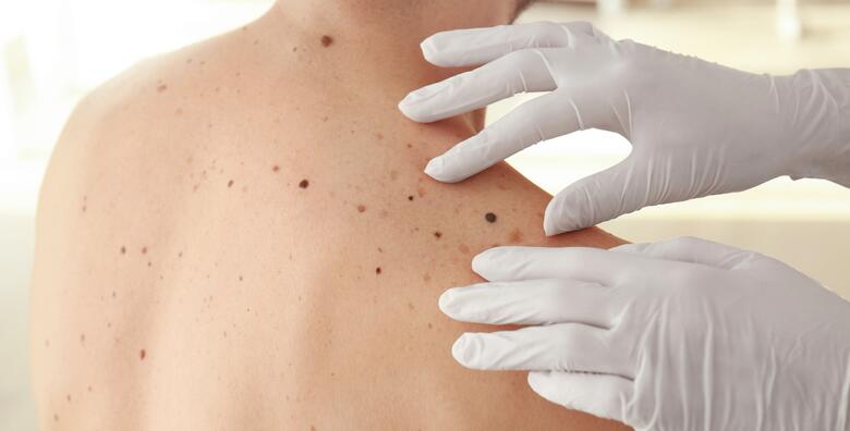 Budite sigurni u zdravlje svoje kože i prepustite se u ruke stručnjaka uz dermatoskopski pregled cijelog tijela ili do 5 madeža u Poliklinici dr. Džepina