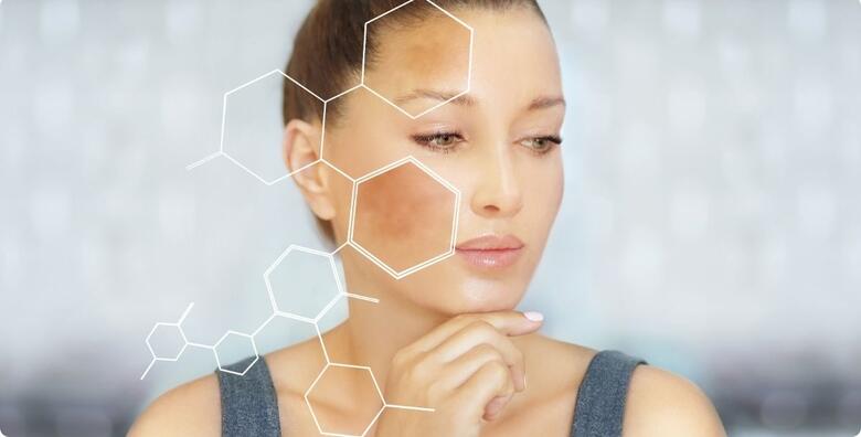 IPL hiperpigmentacije -41%