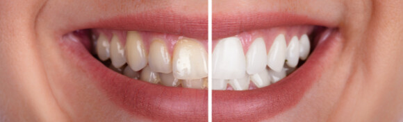 Nesigurni ste u svoj osmjeh? Odlučite se za izbjeljivanje ZOOM tehnologijom, čišćenje zubnog kamenca i poliranje profesionalnom pastom uz GRATIS pregled i konzultacije