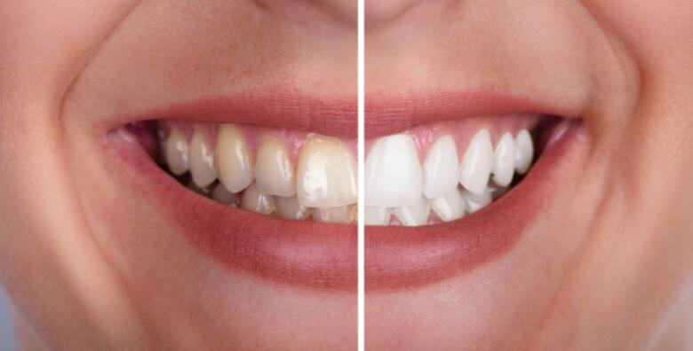MEGA POPUST: 71% - Nesigurni ste u svoj osmjeh? Odlučite se za izbjeljivanje ZOOM tehnologijom, čišćenje zubnog kamenca i poliranje profesionalnom pastom uz GRATIS pregled i konzultacije (Ordinacija dentalne medicine Dami Dent)