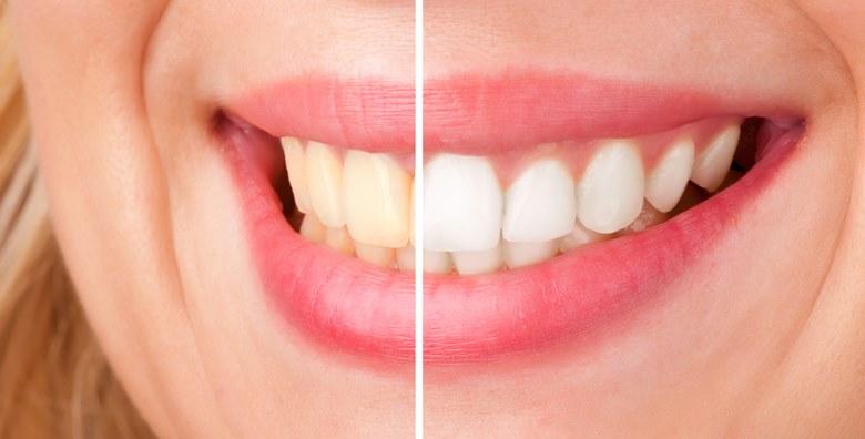 Izbjeljivanje zubi -69% VG