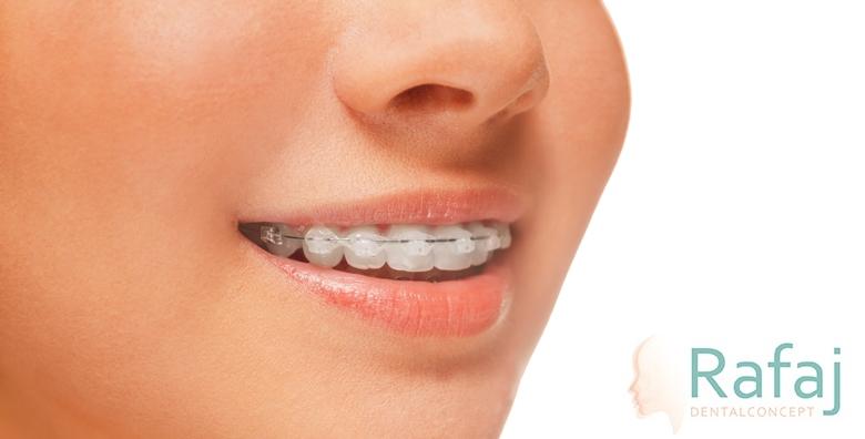 POPUST: 39% - Samoligirajući metalni apartić za zube - donja ili gornju čeljust uz uključene retencije i sve preglede u ordinaciji Dental Concept Rafaj za 4.250 kn! (Dental Concept Rafaj)
