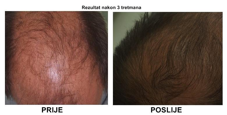 Muči vas ćelavost? Potaknite rast kose uz bezbolan, 100% prirodan tretman za 599 kn!