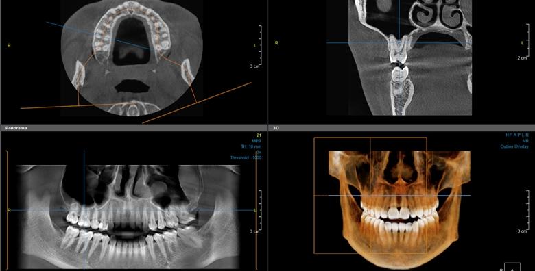 CBCT 3D snimka kompletne gornje i donje čeljusti uz detaljnu analizu snimke, besplatan dentalni pregled dr.med.dent. MSc of Oral implantology i konzultacije za 399 kn!