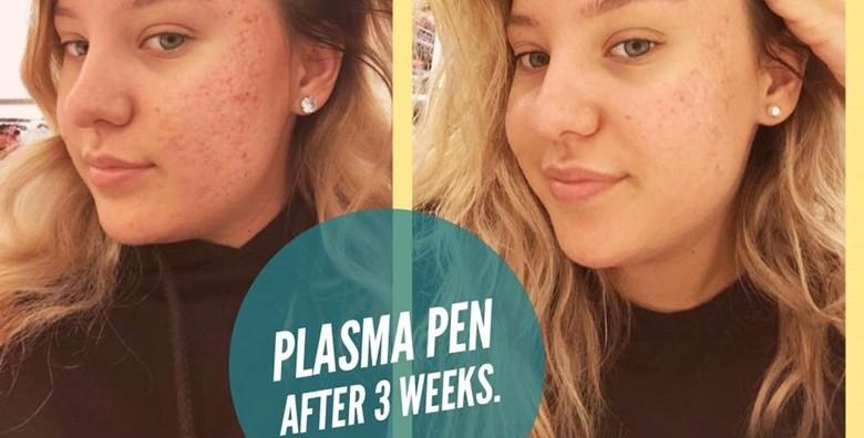 [PLASMA PEN] Uklanjanje ožiljaka od akni inovativnim tretmanom!Najčešće je dovoljan samo 1 dolazak za postizanje željenih rezultata!