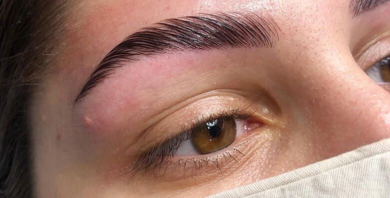 Brow lift -28% Trešnjevka