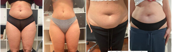 SVJETSKI HIT TRETMAN! Najbolji tretman zamrzavanja masnih stanica CryocoolSculpting 360 ili 4D kojeg koriste svjetski poznate osobe u Studiju ljepote Manuela