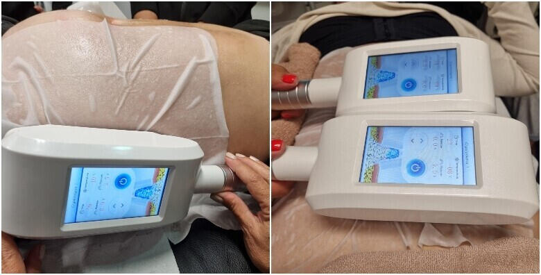 Zamrzavanje masnih stanica uz 1 ili 3 Cryocoolsculpting 360° i Tesla Emslim Neo/RF od 979 kn!