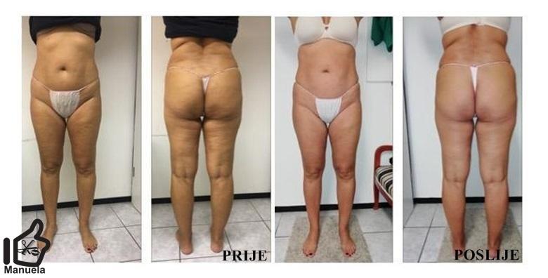 3 Vacuslima i 3 limfne drenaže - do 10 cm manje već nakon prvog dolaska za 749 kn!
