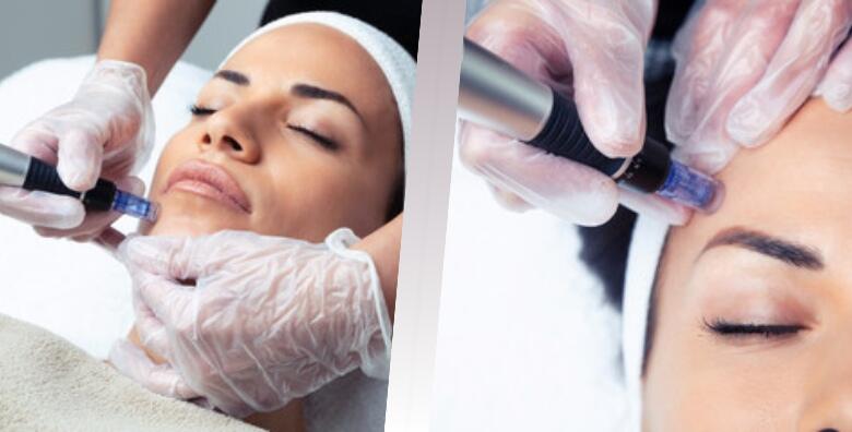 Dermapen terapija lica – učinkovito zategnite i pomladite kožu lica te smanjite vidljive bore uz anti age tretman u Poliklinici Đurić