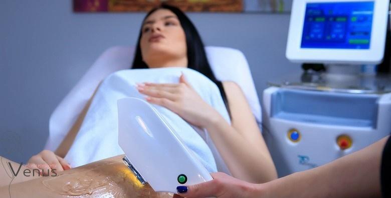 Lasersko uklanjanje dlačica diodnim laserom - tretman cijelih nogu i bikinija za SAMO 149 kn!