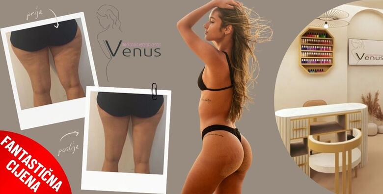 JEDINSTVENA PONUDA! Najbolji svjetski tretman nekirurškog uklanjanja masnih naslaga u NOVOOTVORENOM Medicinsko estetskom centru Venus by Lucija Šarić u SESVETAMA