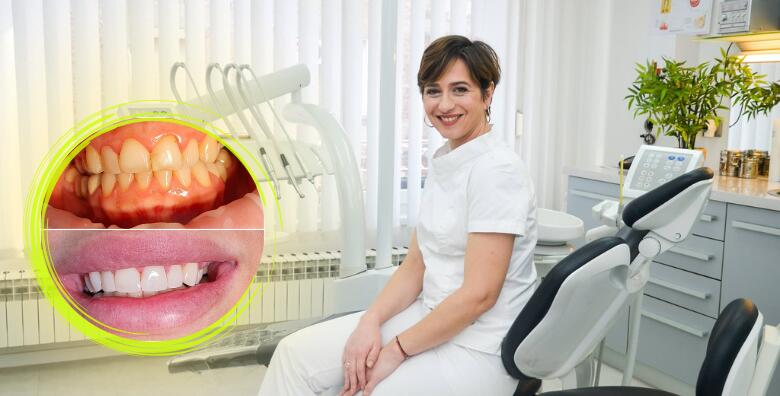 Ispravite oblik, boju, veličinu ili položaj zuba uz uveneer kompozitne ljuskice + pregled te bez skrivanja pokažite svoj novi osmijeh