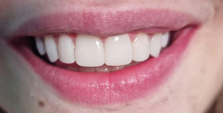 Ispravite oblik, boju, veličinu ili položaj zuba uz uveneer kompozitne ljuskice + pregled te bez skrivanja pokažite svoj novi osmijeh