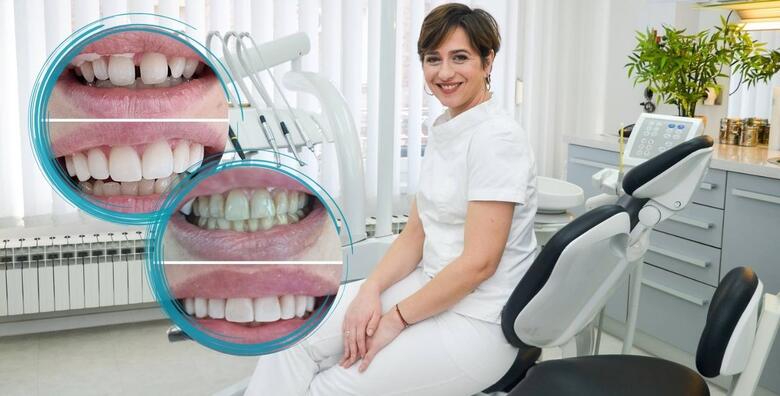 Ispravite oblik, boju, veličinu ili položaj zuba uz uveneer kompozitne ljuskice + pregled te bez skrivanja pokažite svoj novi osmijeh