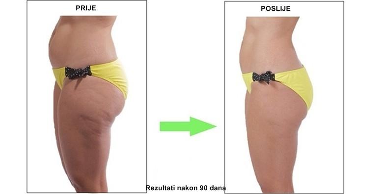 3D CryocoolSculpting - trajno uklonite masne stanice za 1.999 kn!