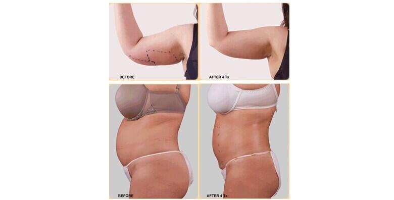 Exilis tretman dijela tijela po izboru od 499 kn!