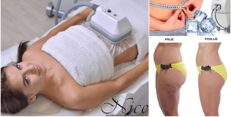 CryocoolSculpting TRAJNO uklanjanje masnih stanica u Studiju Nice za 3.999 kn!