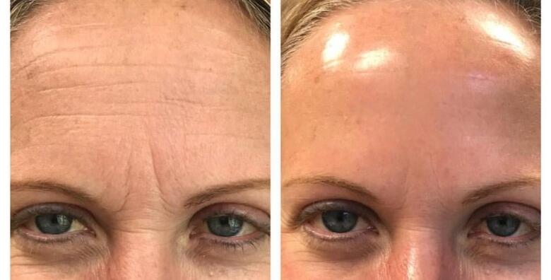 TRETMAN KOLAGEN NITIMA – savršen “boost” tretman kod znakova starenja s odmah vidljivim rezultatima u Kozmetičkom studiju Nice