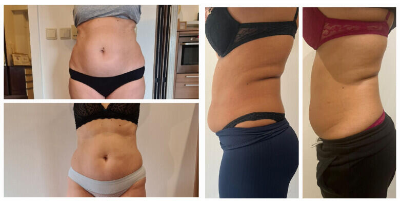 REVOLUCIJA MRŠAVLJENJA uz Green Cold Laser – za 3 tjedna do 2 konfekcijska broja manje! Brzo i sigurno smanjenje masnih naslaga uz 4 tretmana i GRATIS 2 limfne drenaže