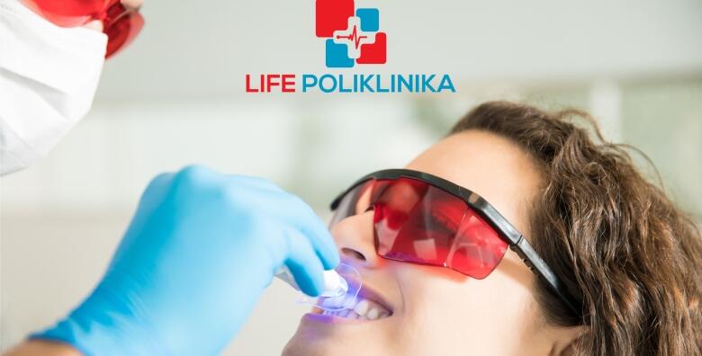 IZBJELJIVANJE ZUBI – izrada udlaga prema individualnim potrebama uz pregled i konzultacije stručnog tima Poliklinike Life i KUĆNI set za izbjeljivanje