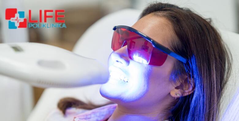 IZBJELJIVANJE ZUBI – izrada udlaga prema individualnim potrebama uz pregled i konzultacije stručnog tima Poliklinike Life i KUĆNI set za izbjeljivanje