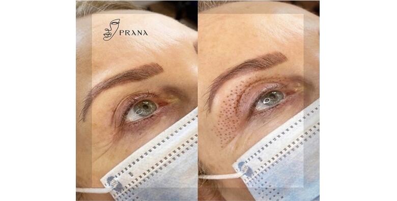 Riješite se problema spuštenih gornjih ili donjih očnih kapaka revolucionarnom tehnikom pomlađivanja Plasma Penom u salonu Prana Esthetic za 599 kn!