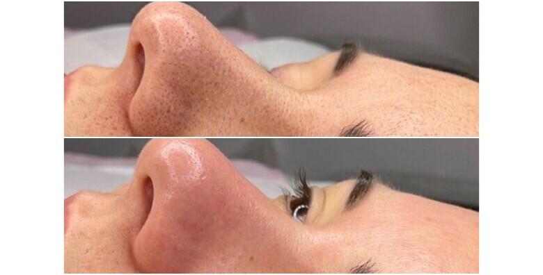 Čišćenje lica ultrazvučnom špatulom – hit tretman i za najosjetljivije kože lica uz piling, masku, kremu i masažu lica u Aura beauty salonu za 150 kn!