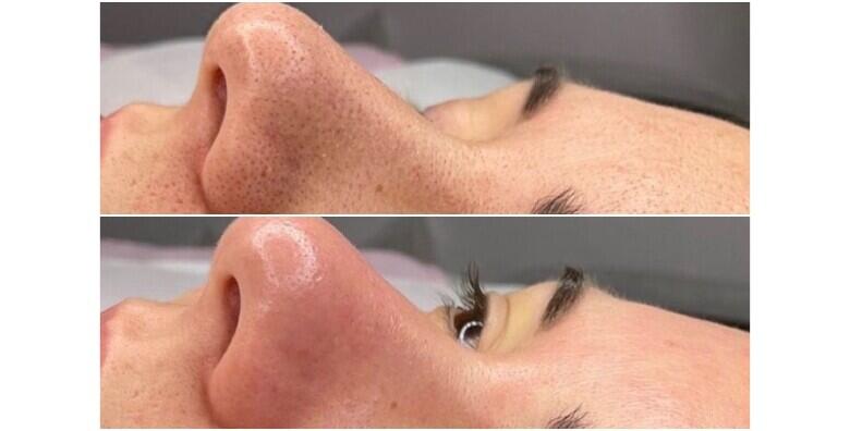 POPUST: 40% - Čišćenje lica ultrazvučnom špatulom uz piling, masku, kremu i masažu lica za savršenu i njegovanu kožu u Aura beauty salonu za 150 kn! (Aura beauty studio)