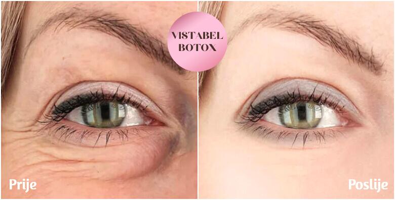 Vistabel 12 jedinica i 0.5 ml svjetski poznatog Restylane filera - najučinkovitijom metodom pomladite vaše oči u Poliklinici Alba Rubra